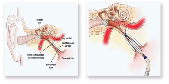 Eustachian Tube Balloon Dilation System